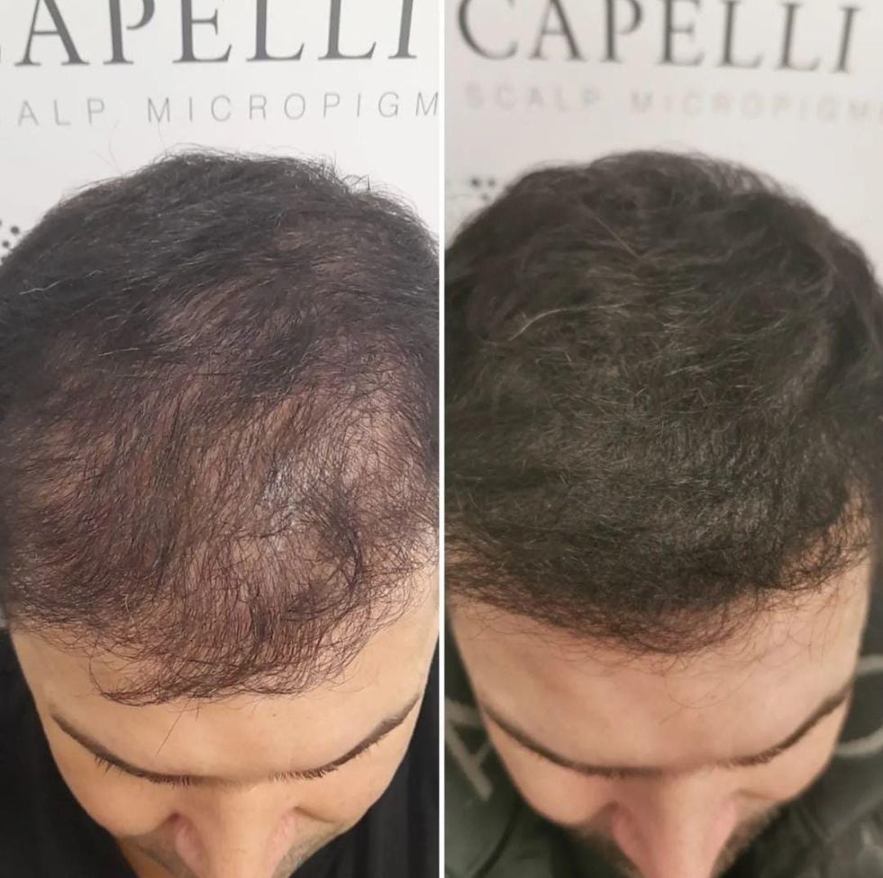 Types of Treatment Scalp Micropigmentation Liverpool SMP